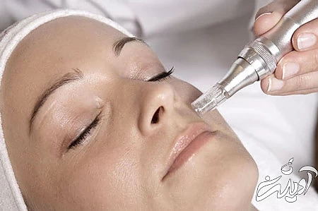 از بين بردن قرمزي جاي جوش از بین بردن قرمزی جای جوش صورت, از بین بردن جای جوش با لیزر, راه های از بین بردن جای جوش